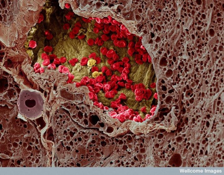 Freeze-Fracture Scanning Electron Microscopy Image of Melanoma Skin Cancer