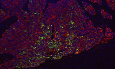 Basal-Like Breast Cancer