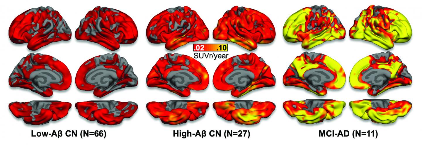 Automated Imaging Reveals Where TAU Protein Originates in the Brain in Alzheimer's Disease (3 of 3)