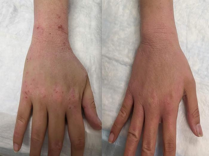 Hand and wrist, before and after TSW treatment