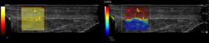 Patellar tendon elastography