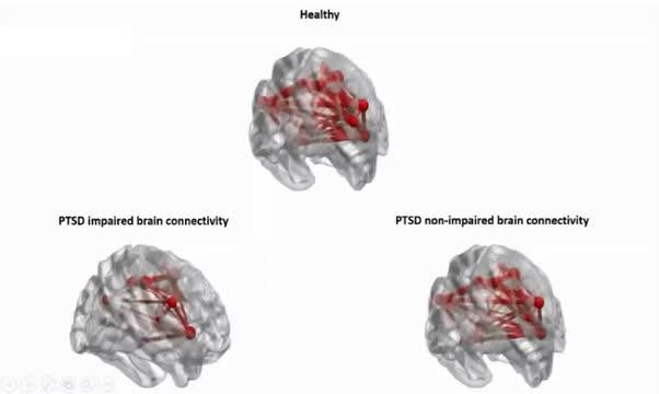 Unique Patterns of Brain Activity Predict Treatment Responses in Patients with PTSD (1 of 2)