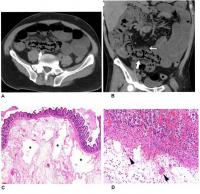 Imaging Reveals Bowel Abnormalities in Patients with COVID-19