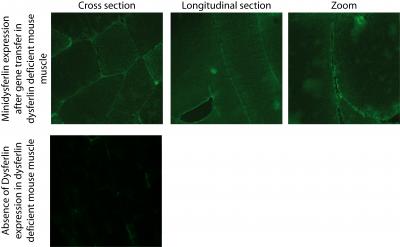 Big Steps for Mini-Genes in Muscular Dystrophy (1 of 6)