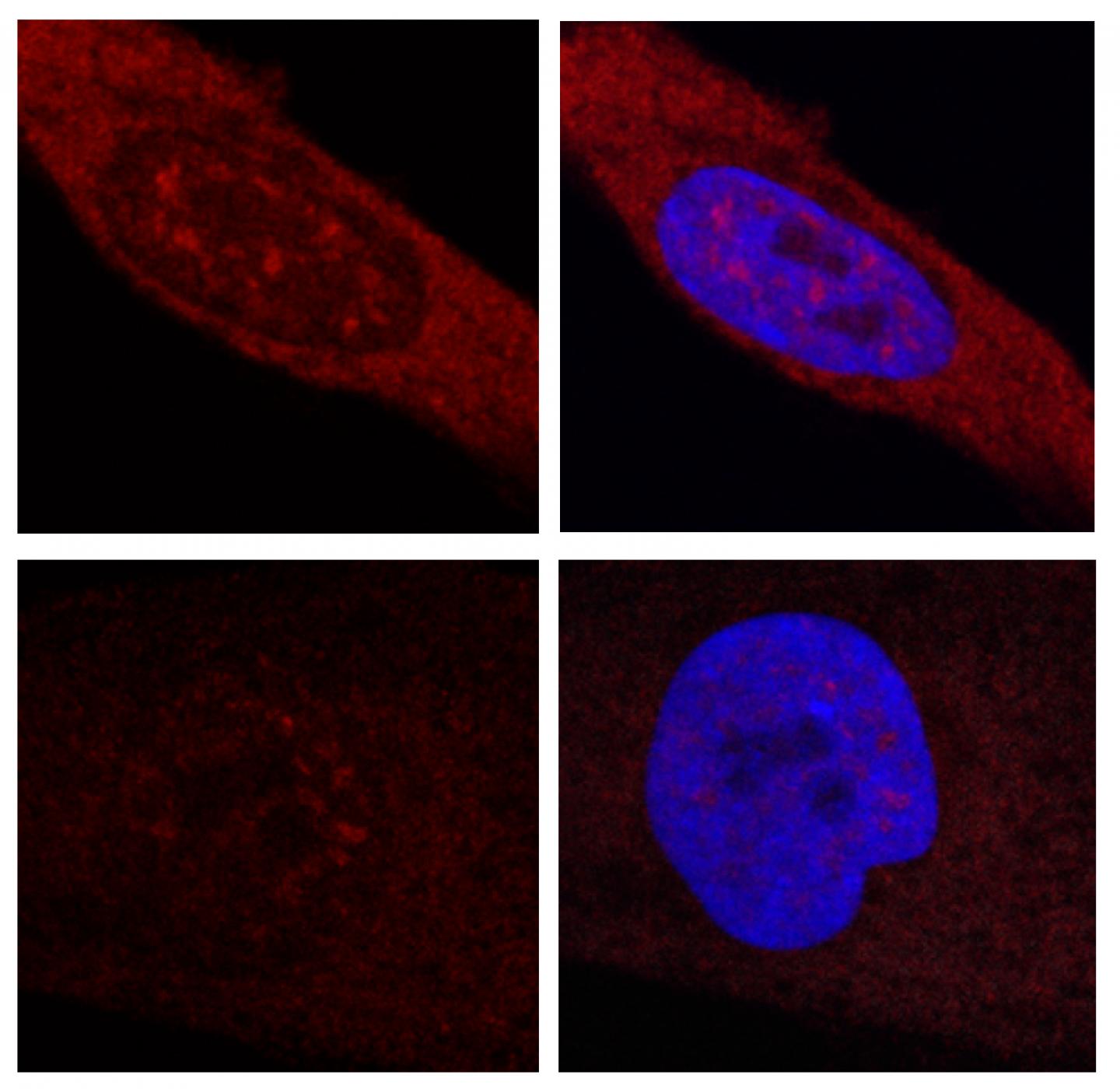 Huntington's Disease Patient Cells