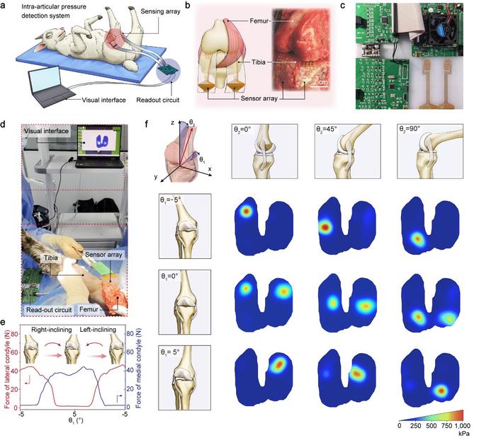 In vivo intra-articular pressure detection in a sheep model using flexible iontronic pressure sensor arrays.