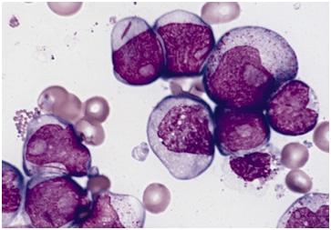 'Alarm Clock' of a Leukemia-Causing Oncogene
