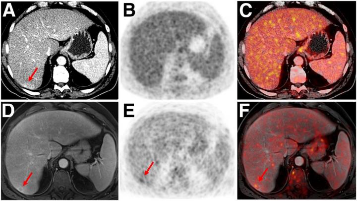 end of life with mesothelioma