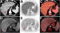 Indeterminate lesion on PET/CT classified by PET/MRI for 53-y-old man with lung cancer.