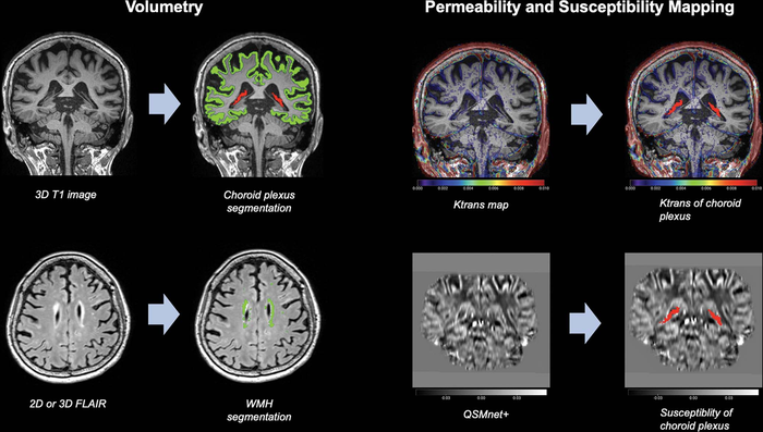 Choroid Plexus Volume Linked to Alzheimer’s Disease