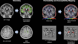 Choroid Plexus Volume Linked to Alzheimer’s Disease