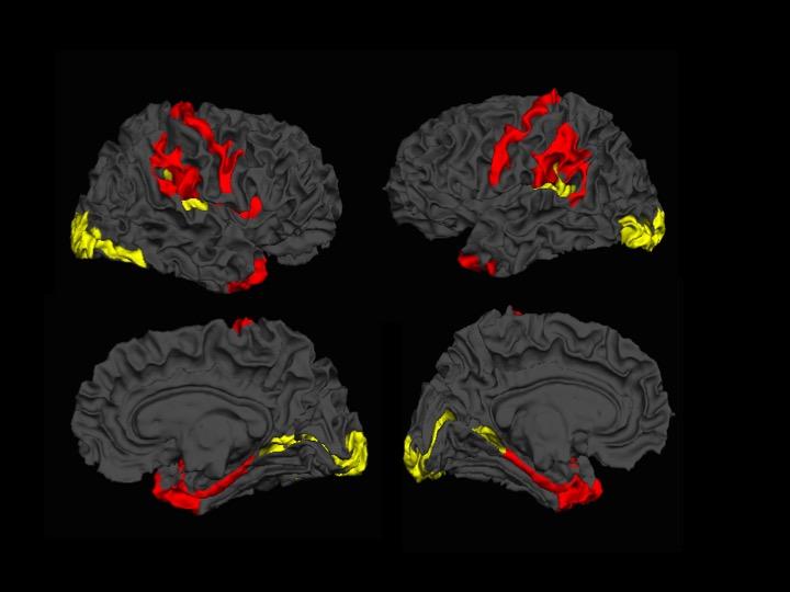 Cortical Thickness: Schizophrenia