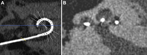 Cochlear Implants Linked to New Bone Formation, Increased Hearing Loss