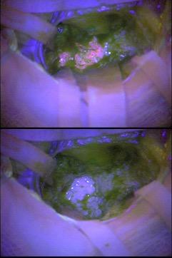 5-ALA in Glioma Surgery