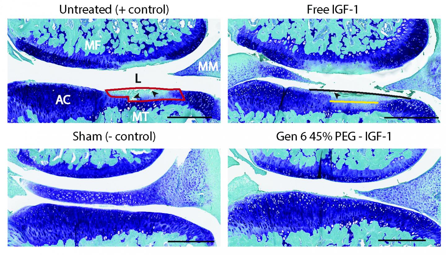 Going from Negative to Positive in the Treatment of Osteoarthritis (1 of 1)