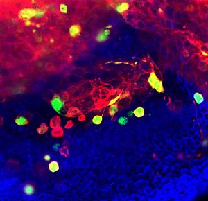 Chromosomal instability in cancer cells causes DNA damage and promotes invasiveness