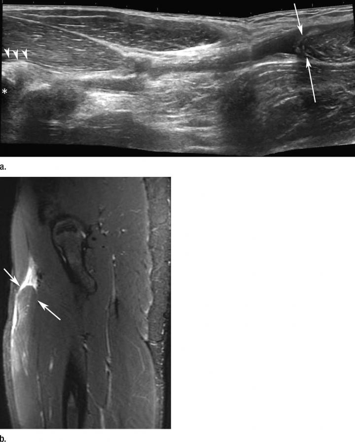 Images in a Sprinter with Acute Anterior Thigh Pain Sustained While Training