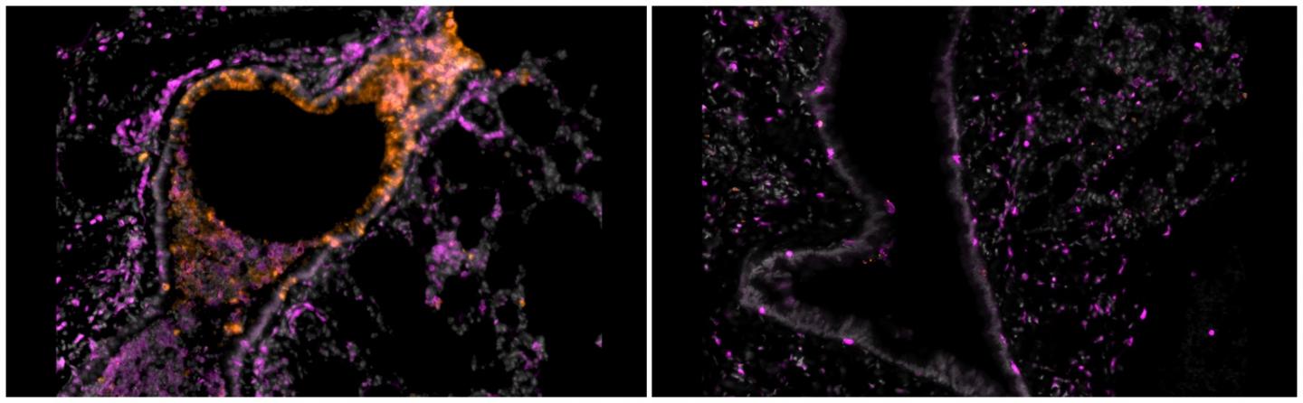 Bronchioles of hamsters sick with COVID-19 untreated (left) and treated with inhalable nanobodies (right).