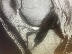 Reconstructed ACL