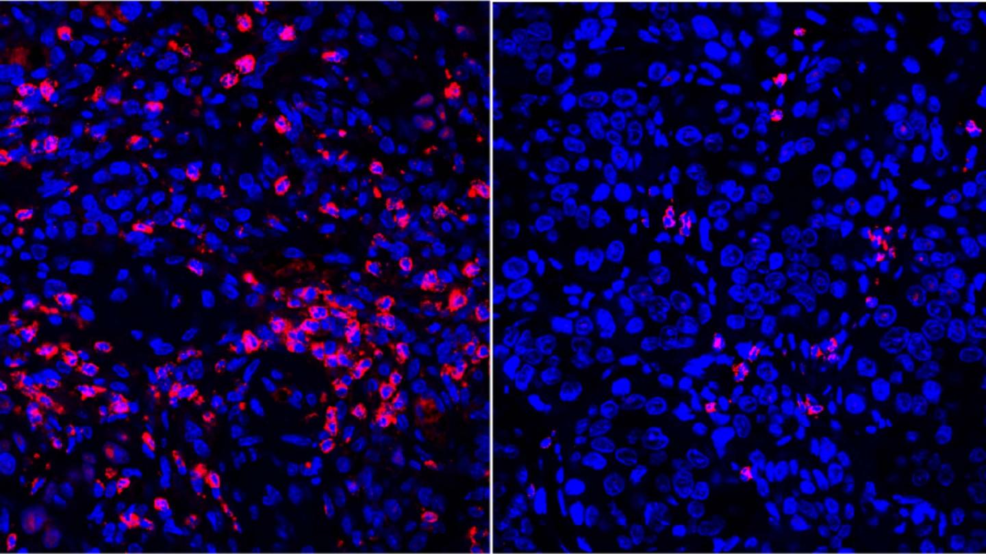 Neutrophils in Pancreatic Cancer