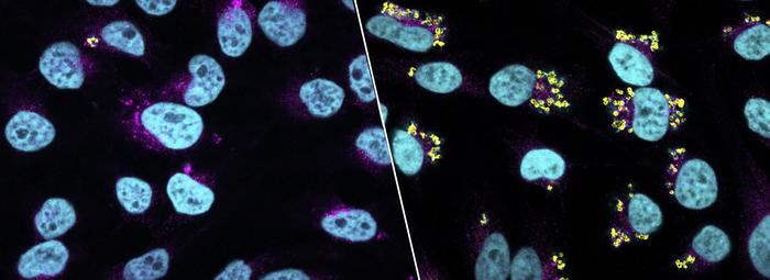 Human epithelial cells infected a cytotoxic S. aureus strain (left) and a non-cytotoxic and persistent S. aureus strain (right)