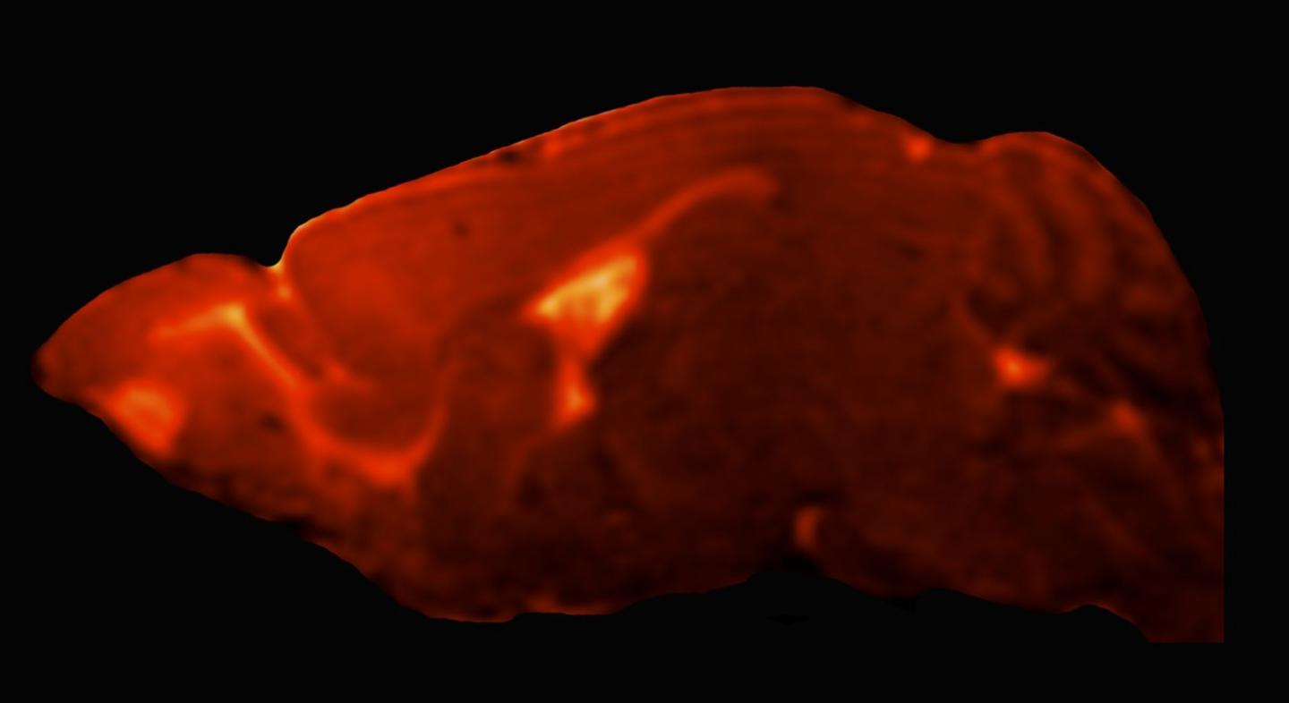 Patterns of Brain Swelling May Explain Susceptibility of Children to Cerebral Malaria