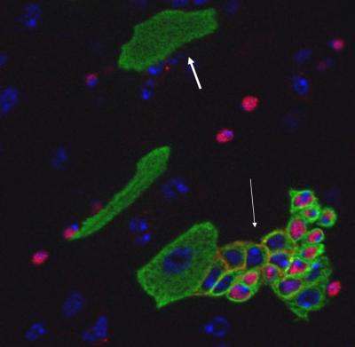 Mutations in Delta Lead to Tumor Formation