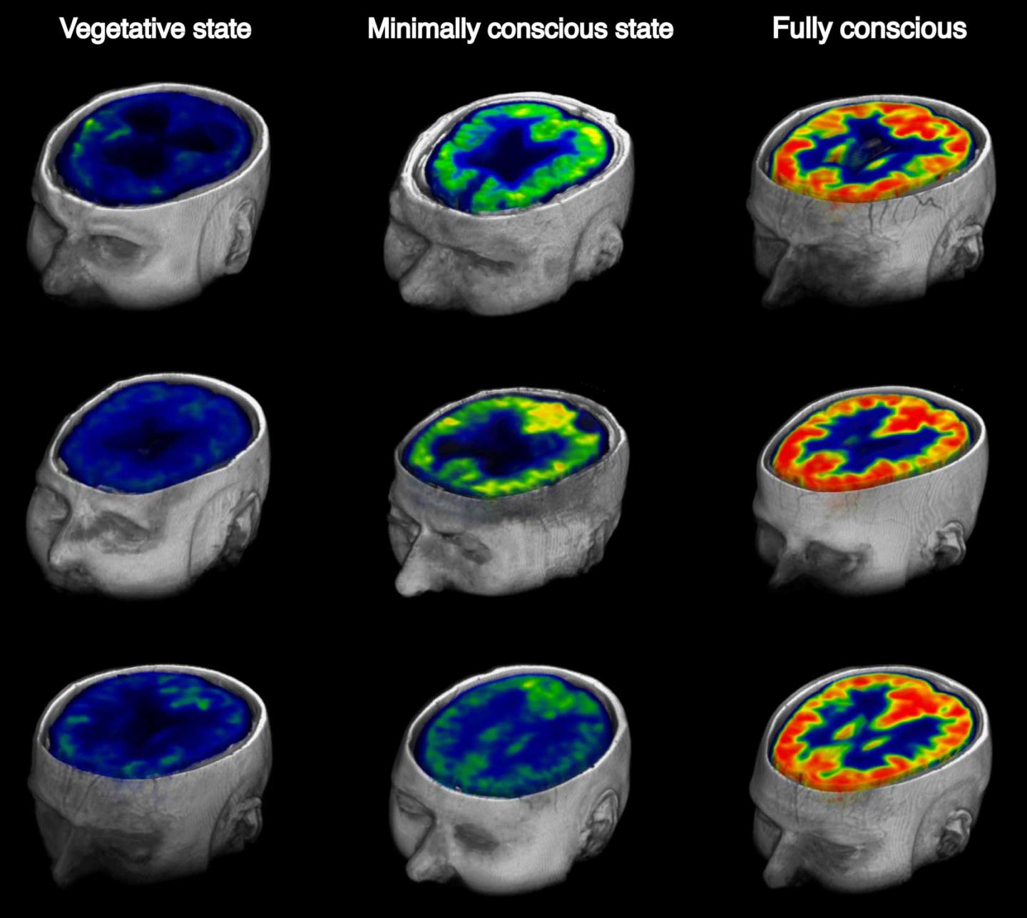 Brain Glucose Metabolism from a Vegetative to Conscious State
