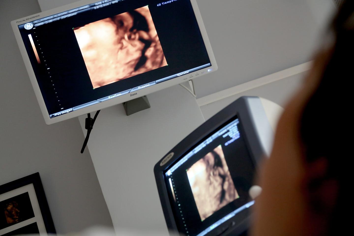 Antenatal Screening for Kidney Problems in Early Childhood