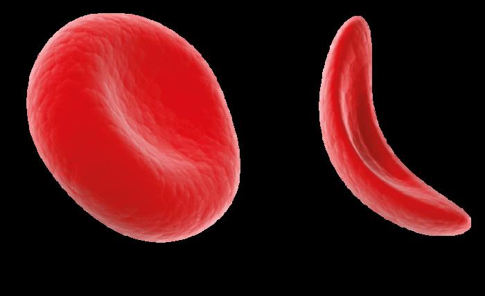 Sickle Cell Red Blood Cells