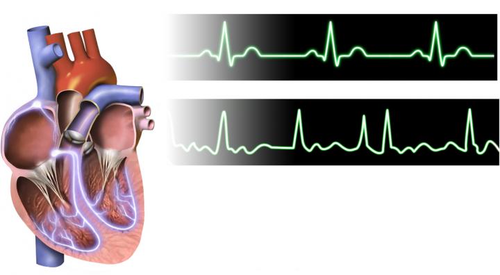 Cause of Killer Cardiac Disease Identified by New Method