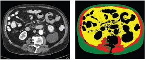 70-year-old White male patient with weight of 79.8 kg, BMI of 29.3, low cardiovascular risk factors (nonsmoker, no diabetes diagnosis, blood pressure of 120/78)