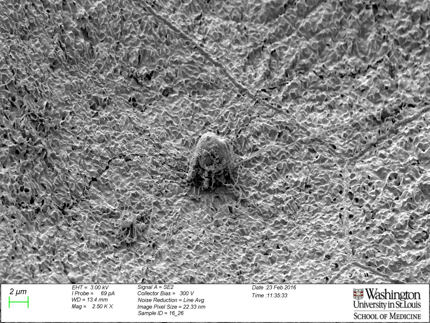 Vaginal bacterium triggers recurrent E. coli EurekAlert!