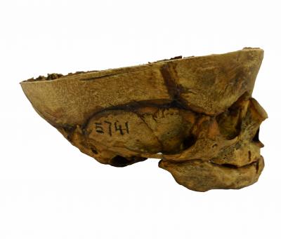 Craniotomy on the Skull of a Fetus