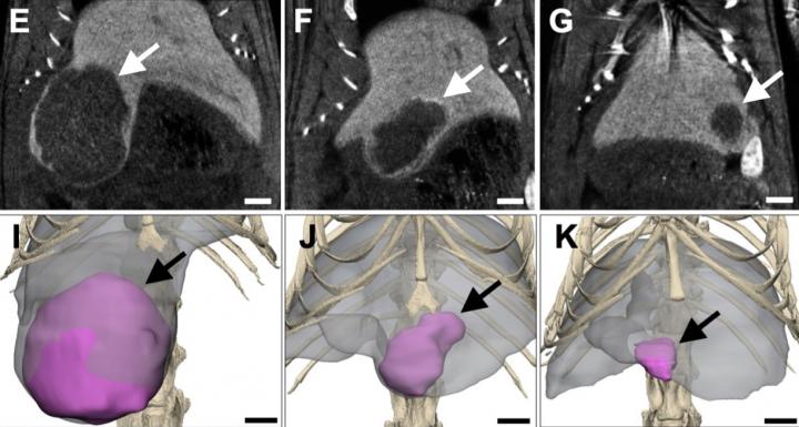 Tumor-Killing Liquid Offers A Safer "Bridge" Therapy for Patients with Liver Cancer (1 of 3)