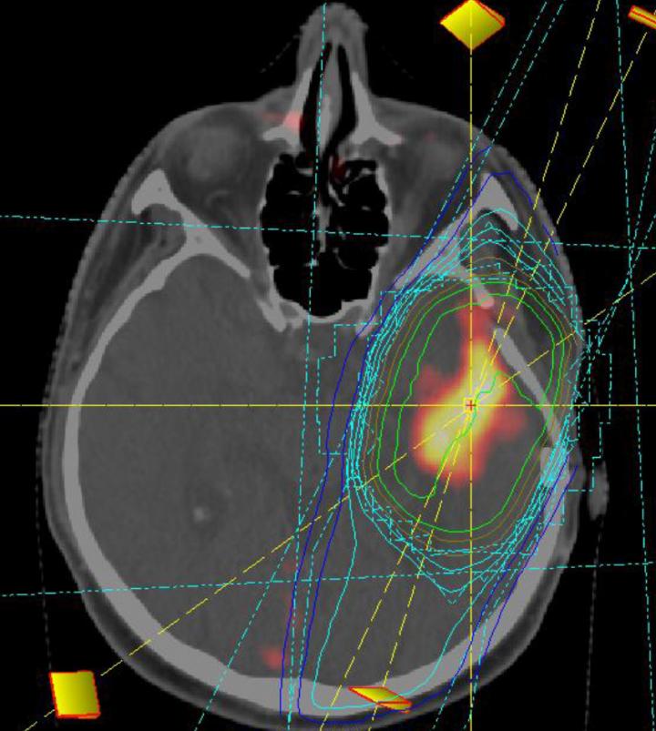 Glioblastoma