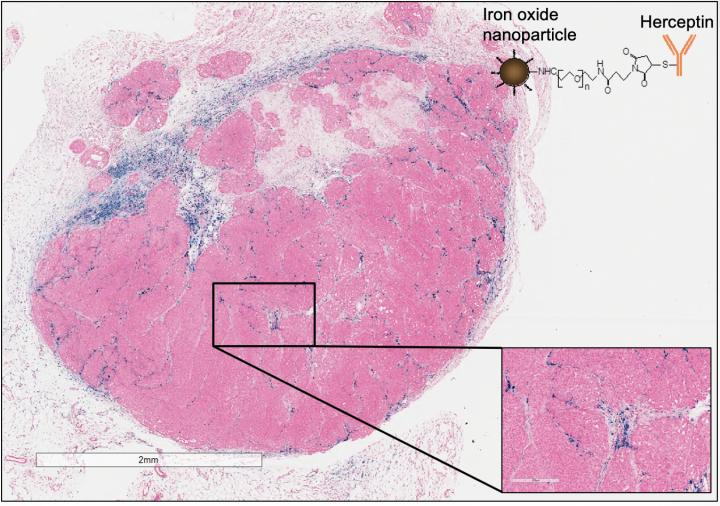 HER2+ Tumor