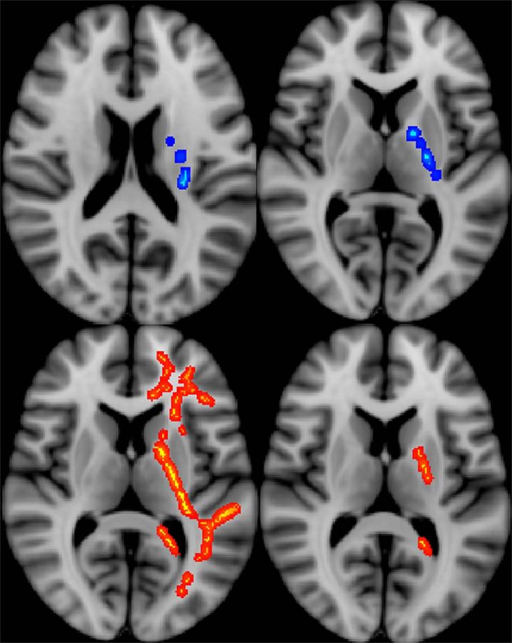 Imaging Predicts Long-Term Effects in Veterans with Brain Injury (3/3)