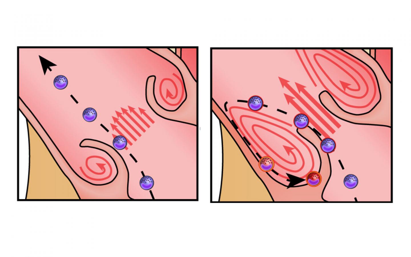 Aortic Stenosis and Immune Cells