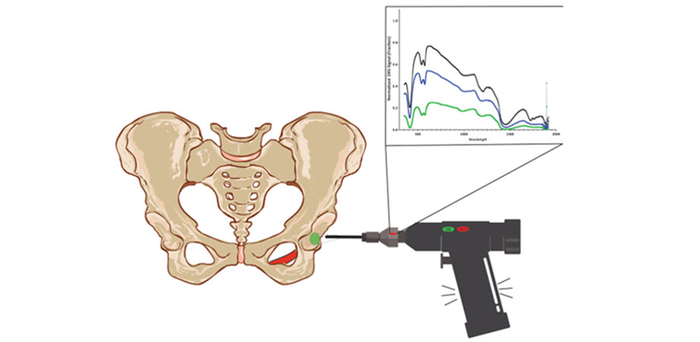 Concept of a “smart” optical drill for total hip arthroplasty.