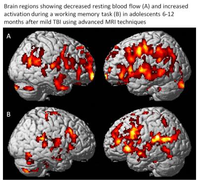 Unclogging blood flow to the brain could open the floodgates for  Alzheimer's treatment