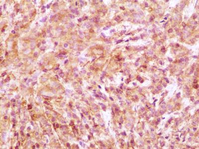 HOXC10 in a Primary Breast Tumor