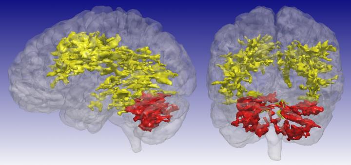 MRI of Bipolar Brain