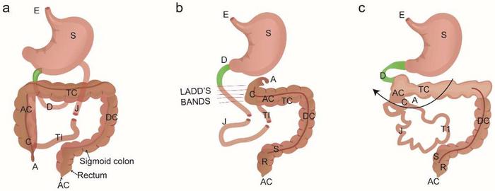 Midgut normal rotation, malrotation and with volvulus