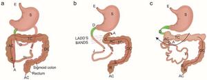 Midgut normal rotation, malrotation and with volvulus