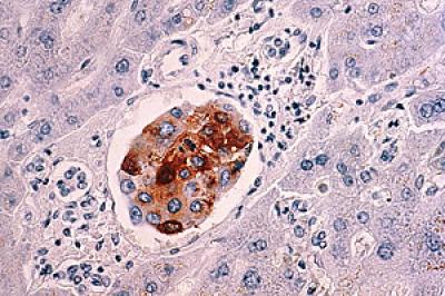 Breast Cancer Cell in Liver