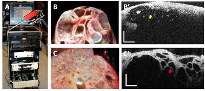Optical Coherence Tomography for Pancreatic Cancer Diagnosis