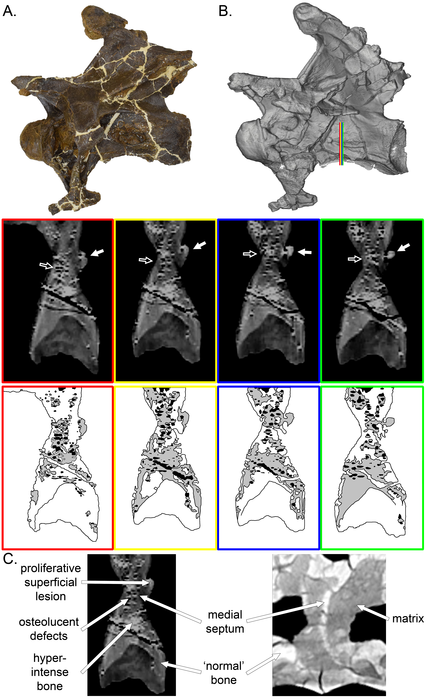 Imaging of infected vertebrae