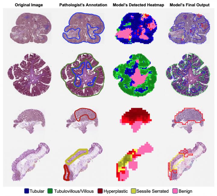 Colorectal Polyp Maps