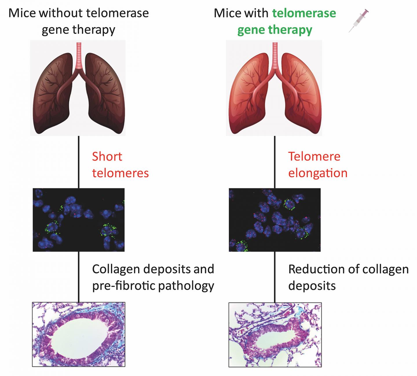 Gene Therapy for Pulmonary Fibrosis Associated with Ageing